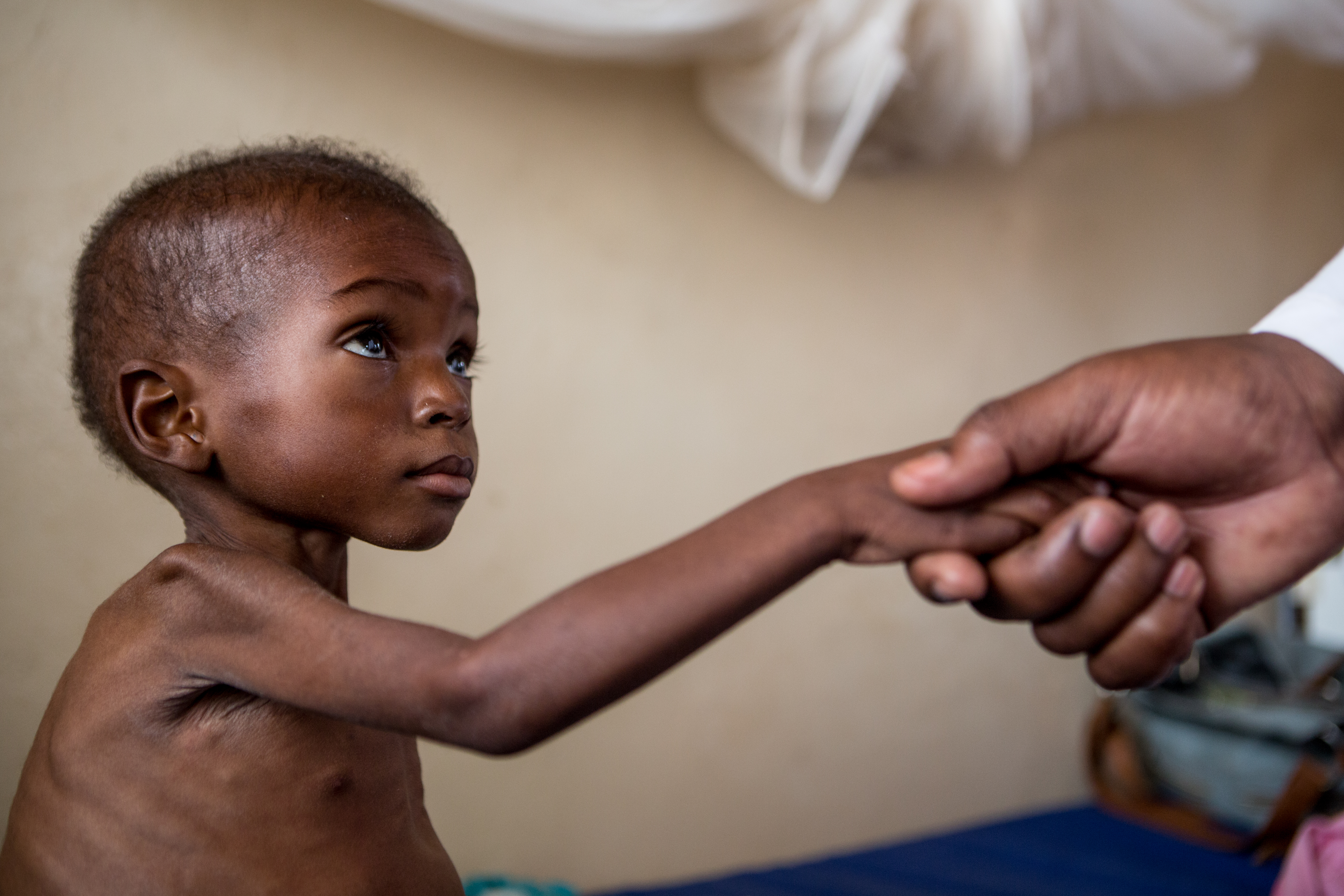 32个月大的Jean Ngoy在DRC的 Haute Katanga省，Katanga本地一家医院的儿科病房中，他患有严重的急性营养不良和HIV。